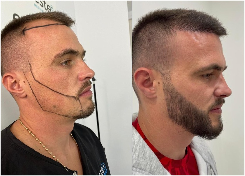 How Does FUE Beard Transplant Work?