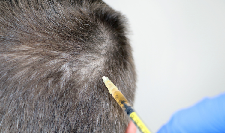 How to Take Care of Your Hair Post Hair Transplant?