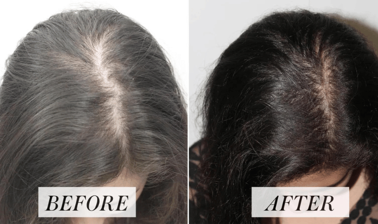 Step-by-Step Guide to PRP Therapy for Hair Loss: What to Expect?