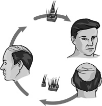 Answers To Frequently Asked Questions About Hair Transplant